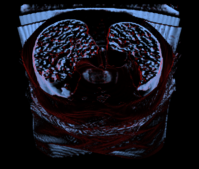 Torso CT, lungs