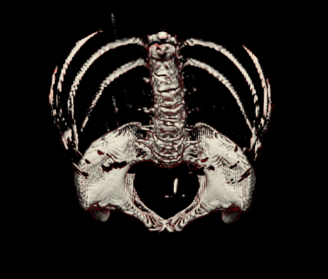 Torso CT, bone
